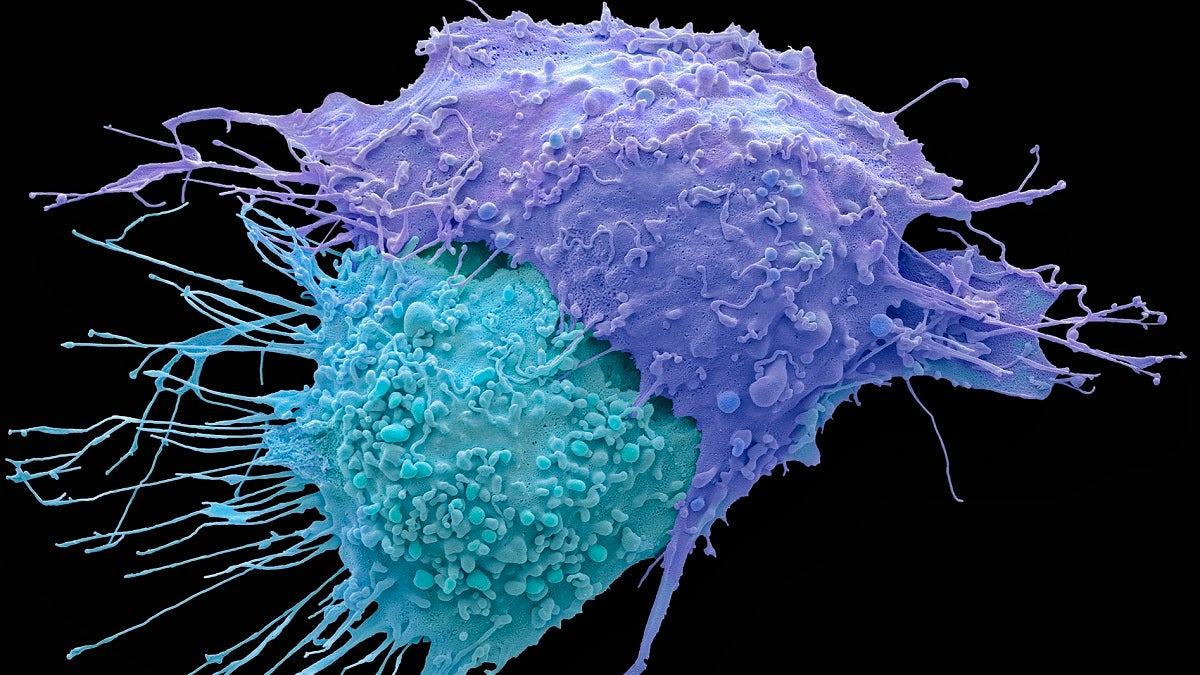 A coloured scanning electron micrograph of ovarian cancer cells